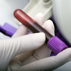 Exame pode descobrir câncer 4 anos antes de aparecimento de sintomas